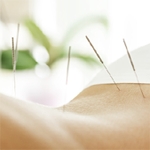 acupuncture